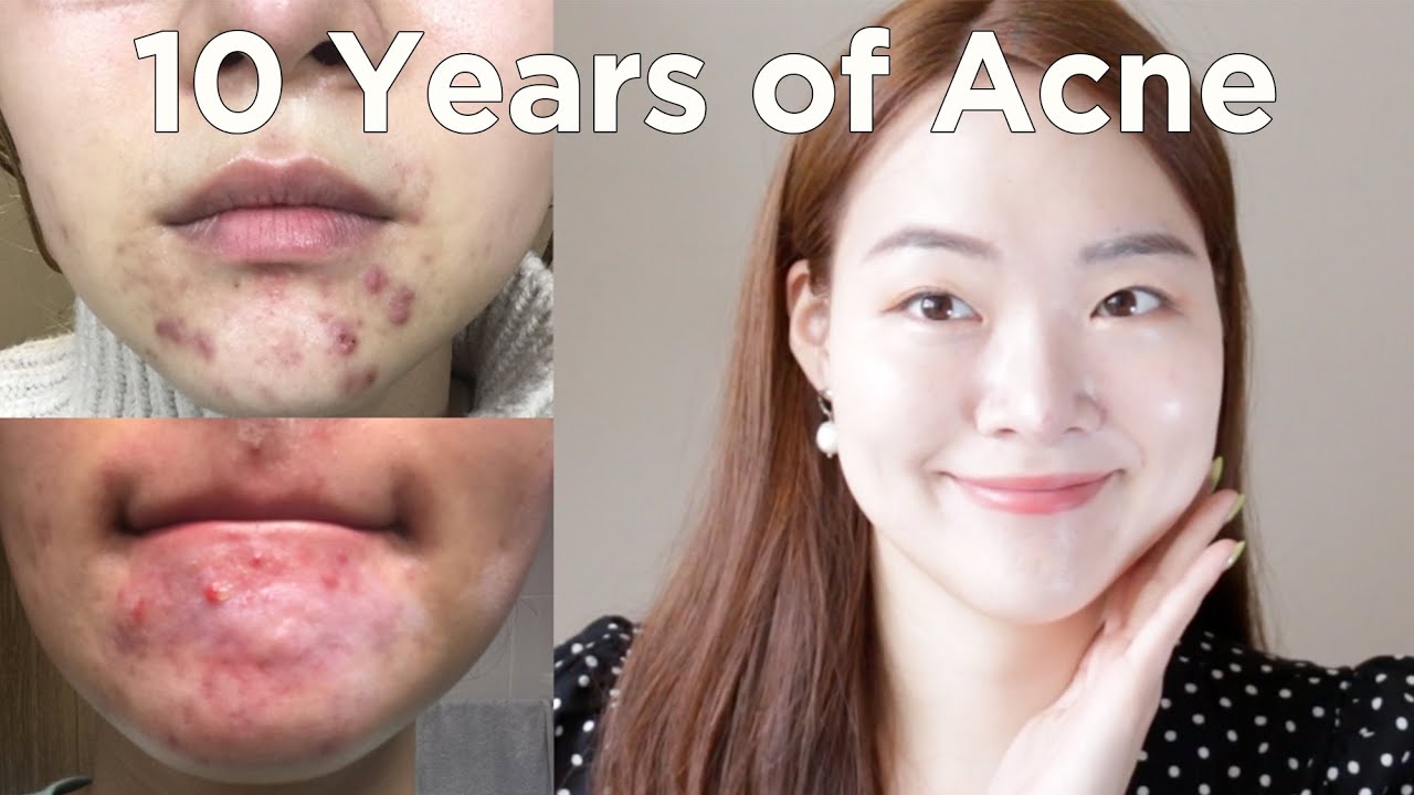 the best skincare for acne (no ad)