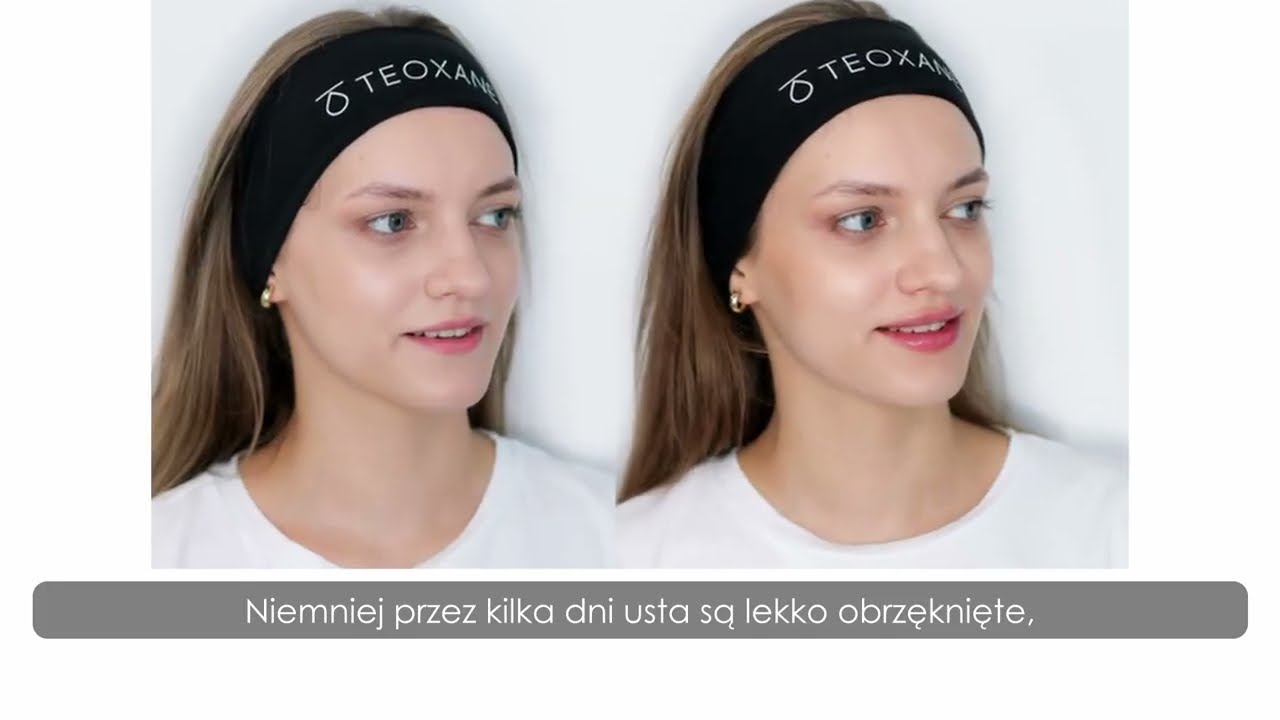 Modelowanie i nawilżanie ust kwasem hialuronowym
