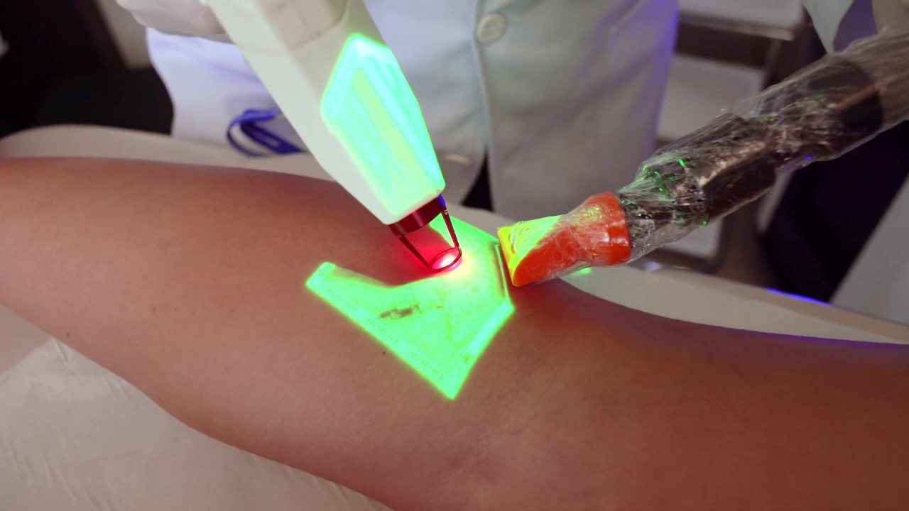 LASER PARA TRATAMENTO DE VASINHOS E VARIZES