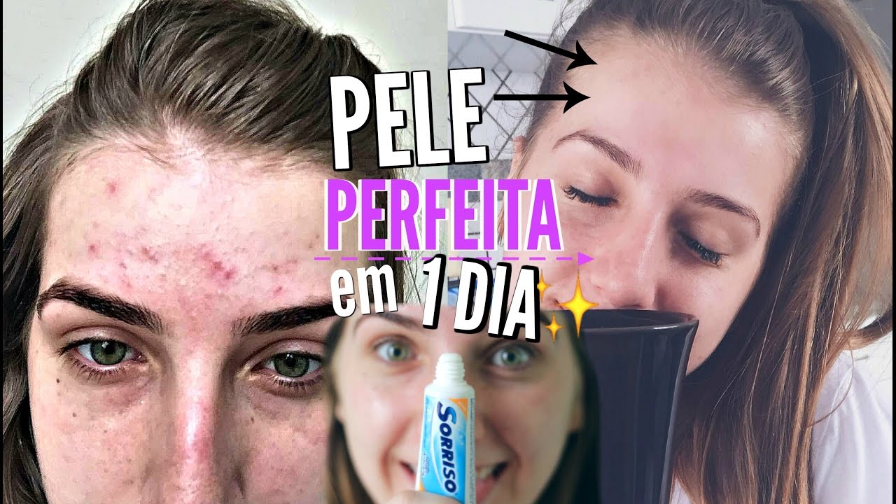 COMO ACABAR COM ESPINHAS EM 1 NOITE!! #1
