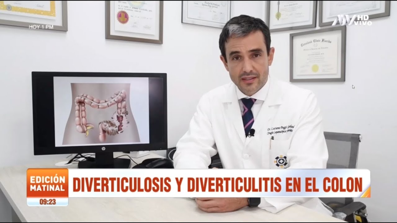 Diverticulosis y diverticulitis en el colon