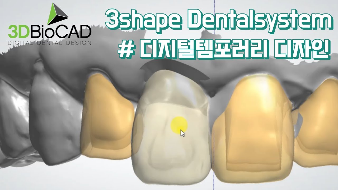 3Shape Dentalsystem 디지털템포러리 디자인
