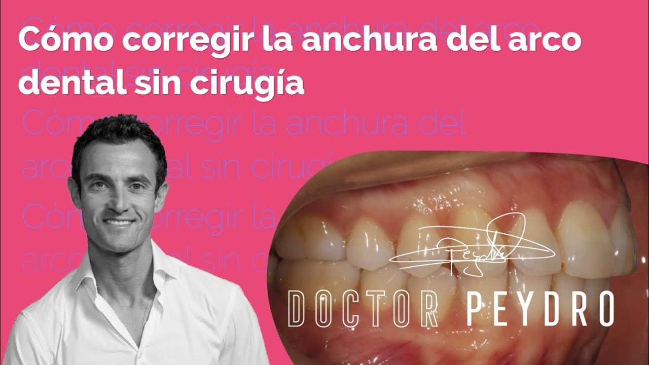 CÓMO corregir una maloclusión de clase II con ORTODONCIA invisible
