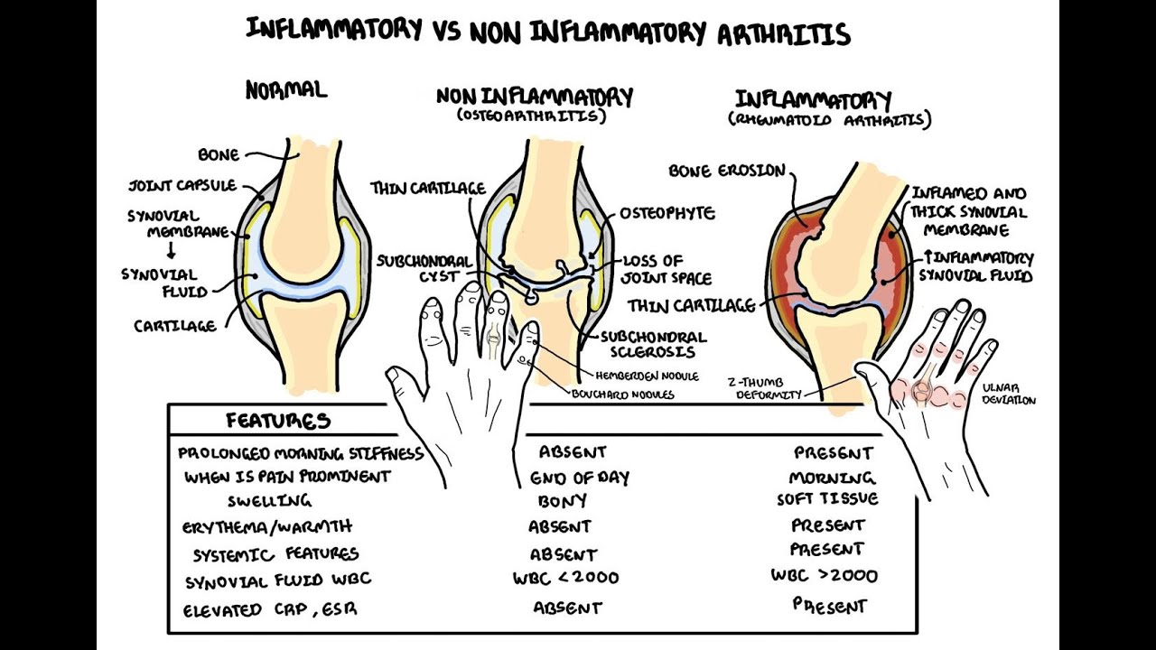 Inflammatory vs non-inflammatory arthritis