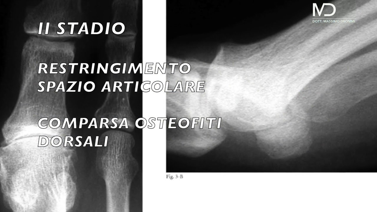 Video 1  alluce rigido Classificazione e patogenesi
