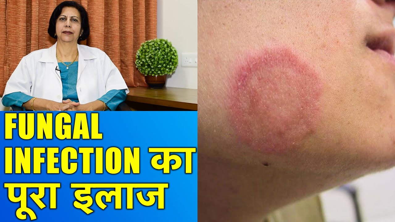 फंगल इन्फेक्शन का पूरा इलाज || Complete Treatment of Fungal Infections