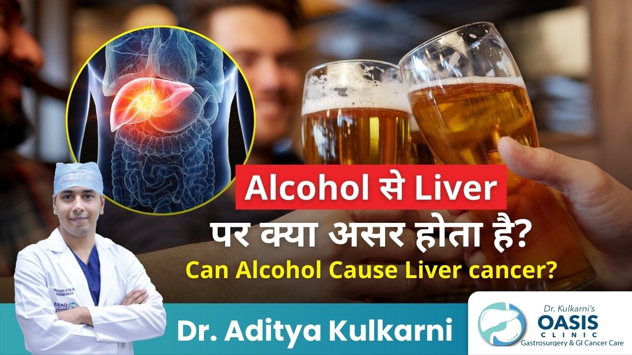 क्या Alcohol पीने से Liver Cancer हो सकता है? | Can Alcohol Cause Liver Cancer? | Dr Aditya Kulkarni