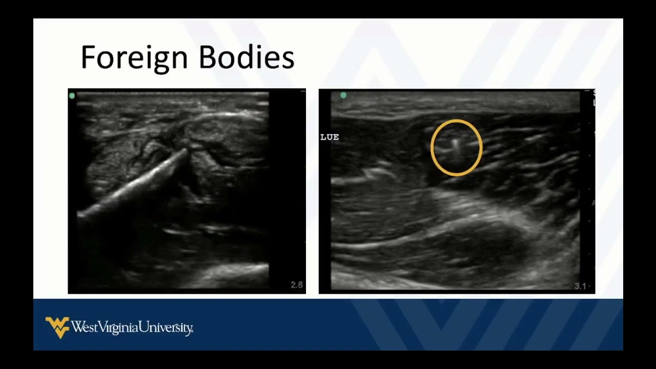 POCUS in Skin and Soft Tissue Infections 2 - Other Findings