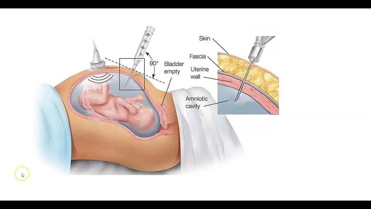 Ch 14 Amniotic Fluid Analysis