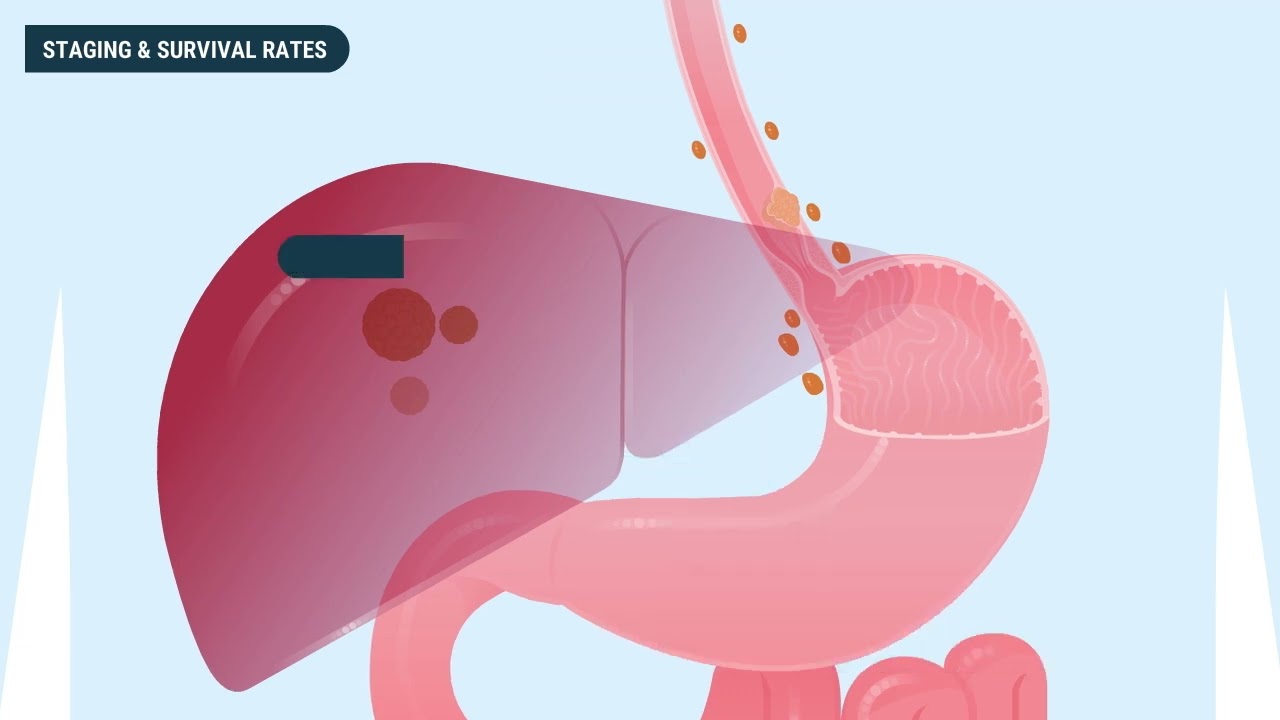 What You Should Know About Esophageal Cancer