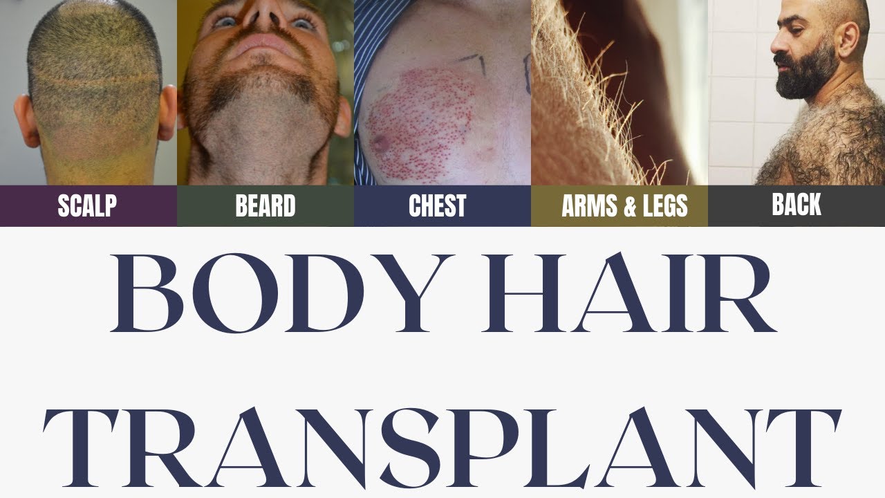 Body Hair Transplant in India | Extensive baldness with Beard, chest and leg grafts