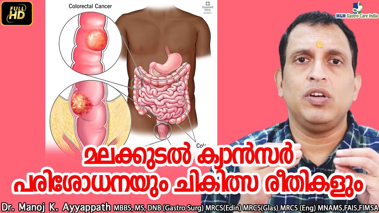 മലക്കുടൽ ക്യാൻസർ | rectal cancer | പരിശോധനയും ചികിത്സ രീതികളും | M&M Gastro Care India