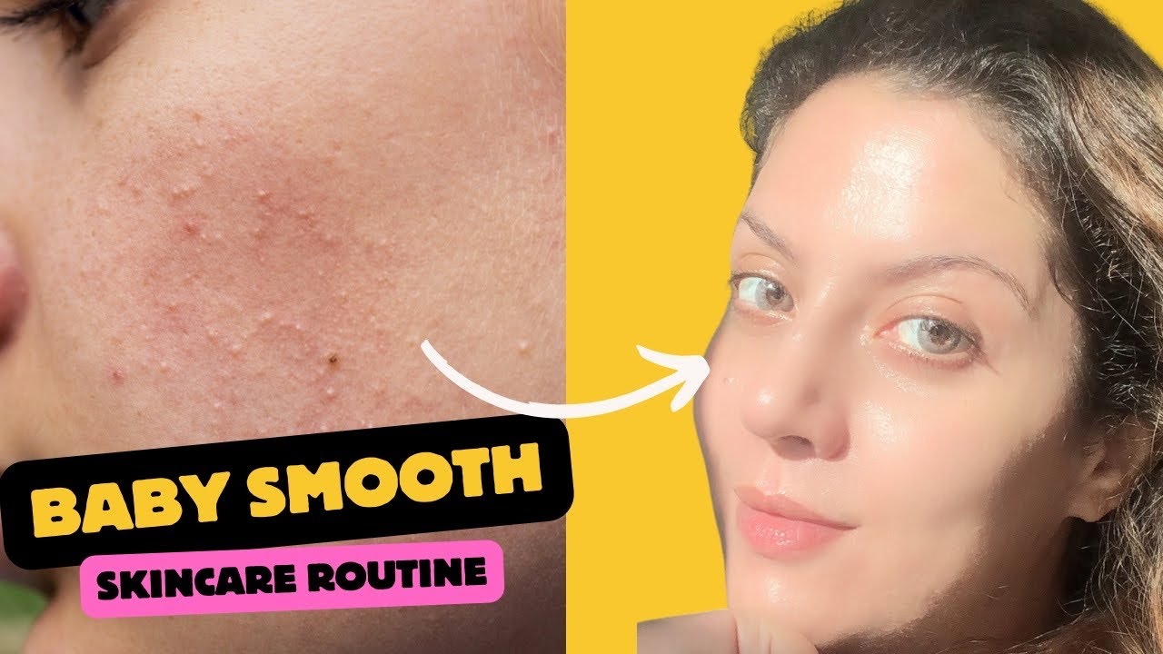 How to get baby soft smooth with no texture | How to treat  closed comodones | Nipun Kapur