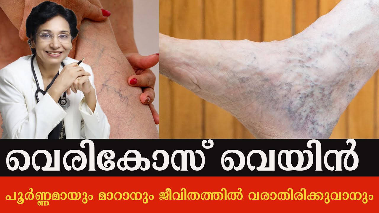 വെരികോസ് വെയിൻ പൂർണ്ണമായും മാറാനും ജീവിതത്തിൽ വരാതിരിക്കുവാനും