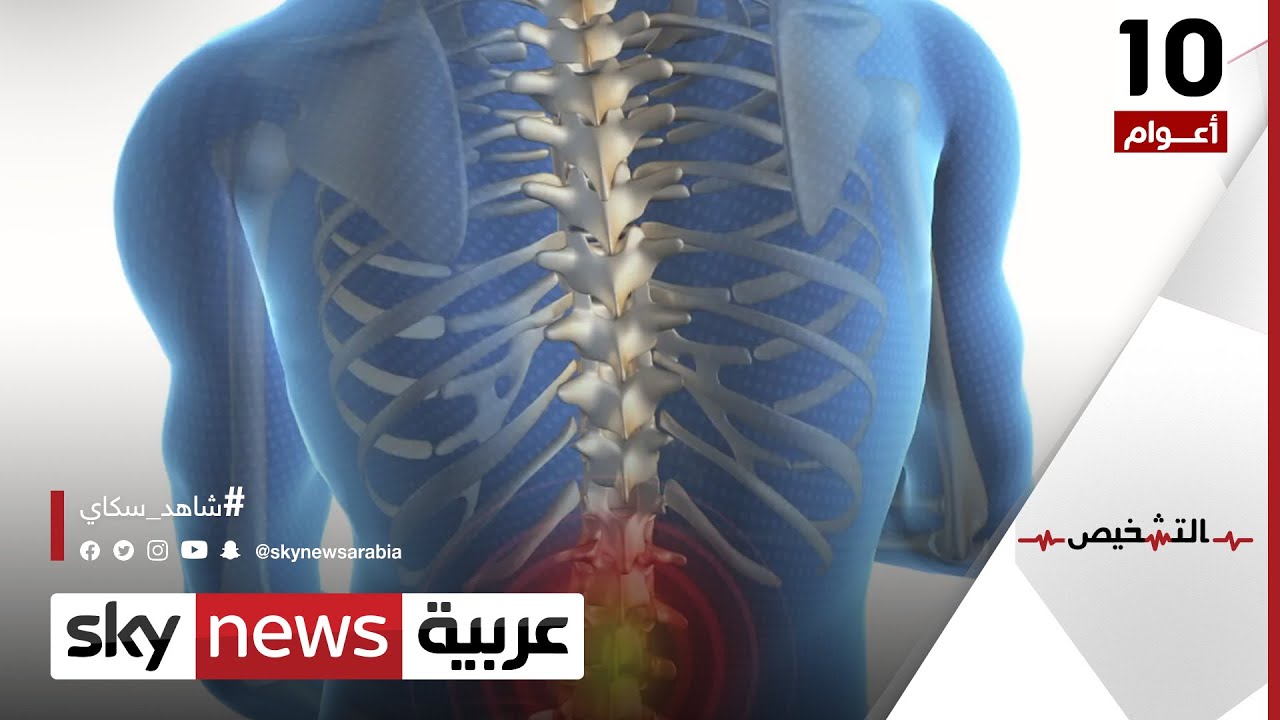 طريقة جديدة لعلاج الجنف وانحناء العمود الفقري | #التشخيص
