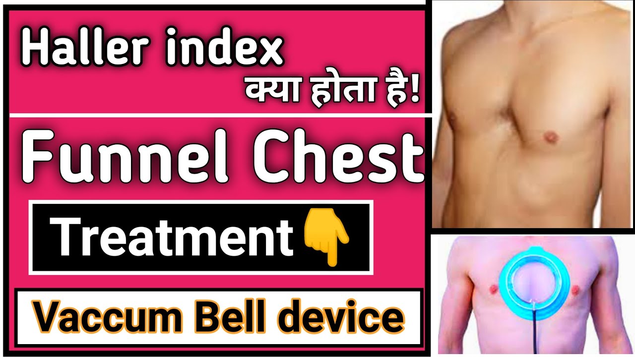 vaccum bell device for funnel chest | Haller index | funnel chest treatment without surgery