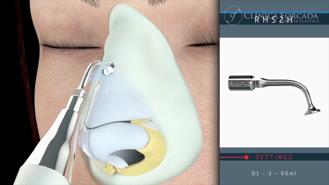 ¿Cómo se realiza una rinoplastia ultrasónica?