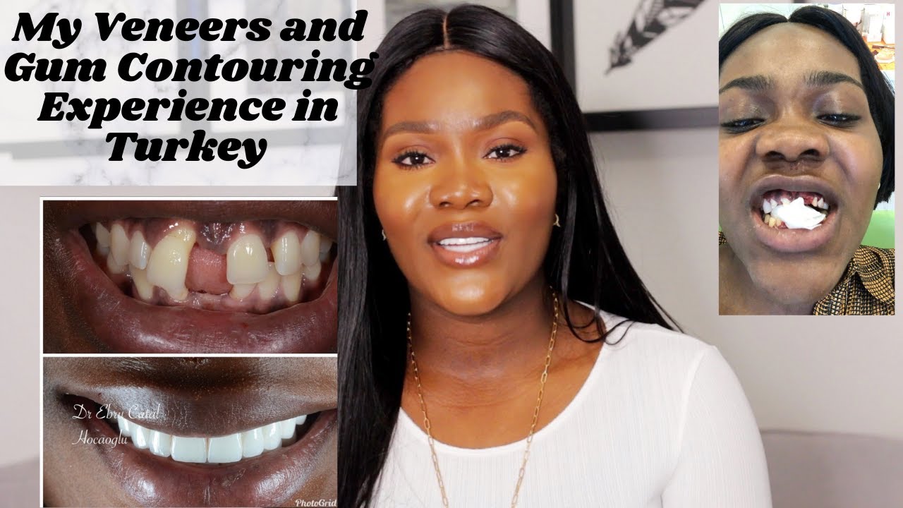 TURKEY ZIRCONIUM PORCELAIN CROWNS EXPERIENCE & GUM CONTOURING | DR EBRU CATAL HOCAOGLU. THE CLINIQUE