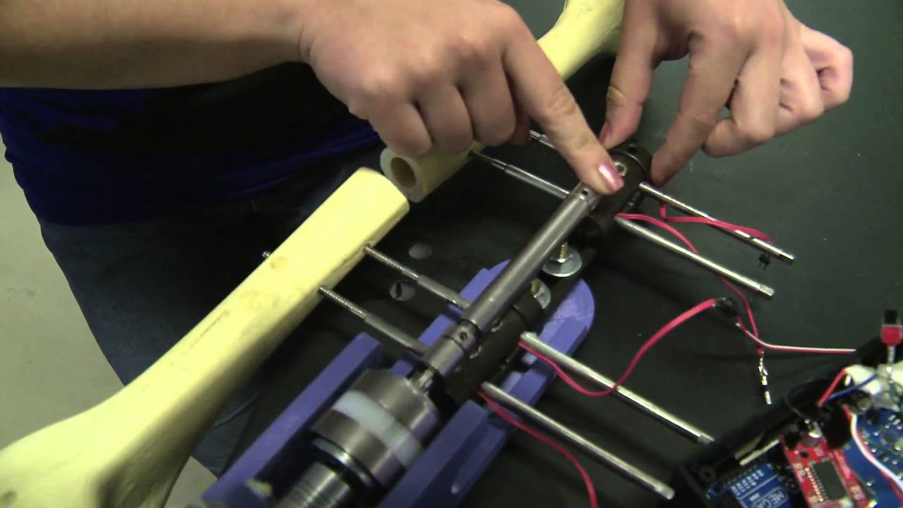 Rice University student engineers automate limb lengthening for kids