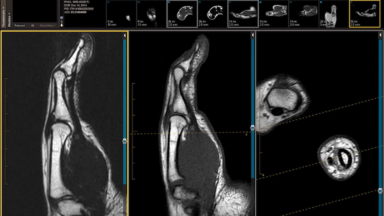 Finger & Thumb MRI: Volar & Dorsal Plates on MRI