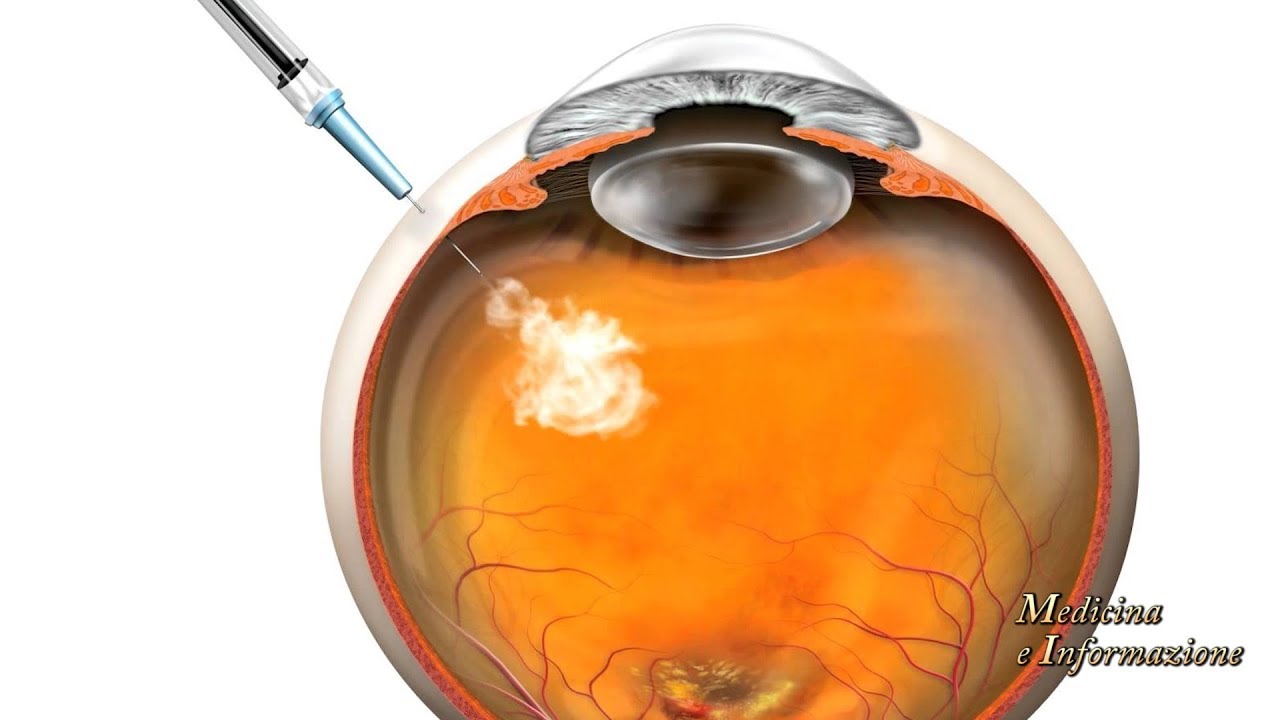 Edema Maculare Diabetico: le nuove iniezioni intravitreali a lento rilascio