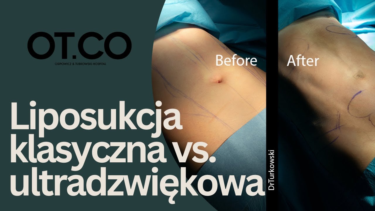 Liposukcja Klasyczna vs Liposukcja Ultradźwiękowa