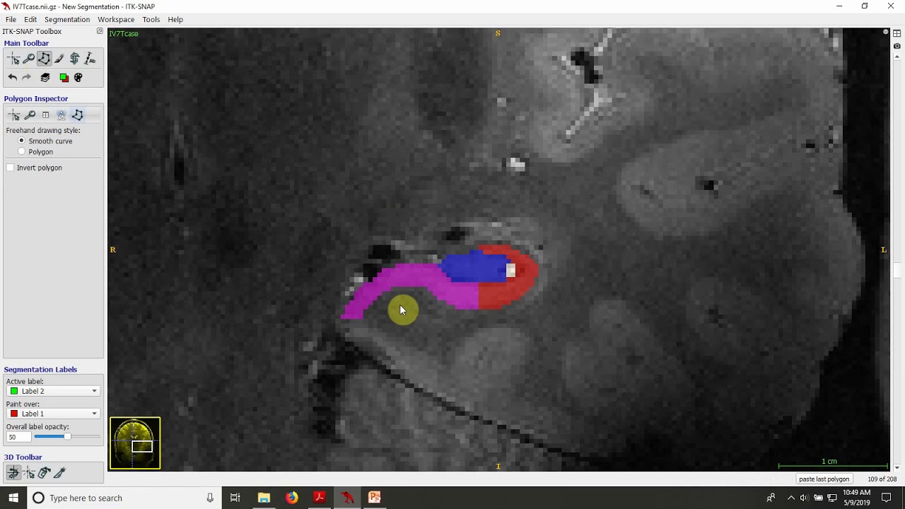 Demonstration of subfield segmentation in the hippocampal body