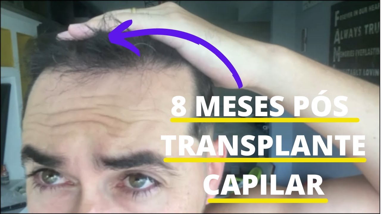EVOLUÇÃO TRANSPLANTE CAPILAR FUE - 8 MESES (O TC É UM INVESTIMENTO ALTO, MAS QUE NÃO TEM PREÇO)