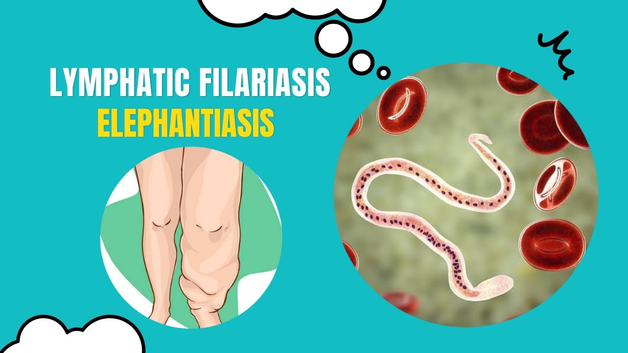 Unlocking the Secrets of Elephantiasis: What You Need to Know