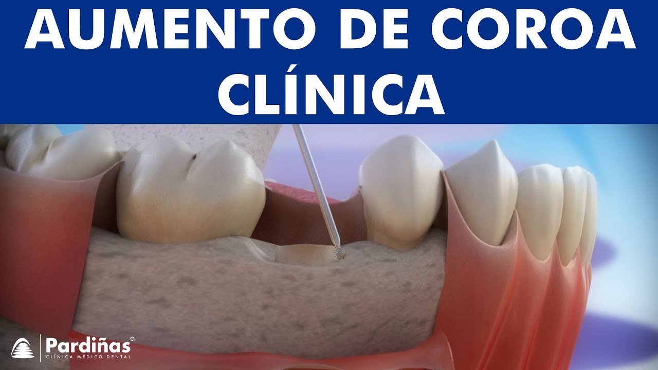 Aumento de coroa cl&iacute;nica &copy;