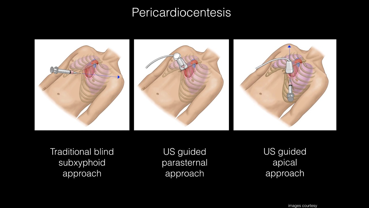 Dual Diagnosis by Bedside Ultrasound