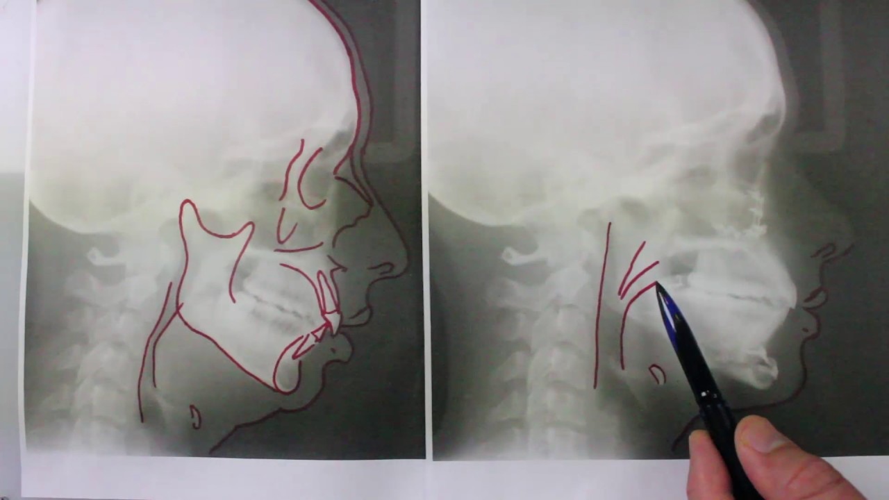 Before and After Jaw Surgery X-Rays
