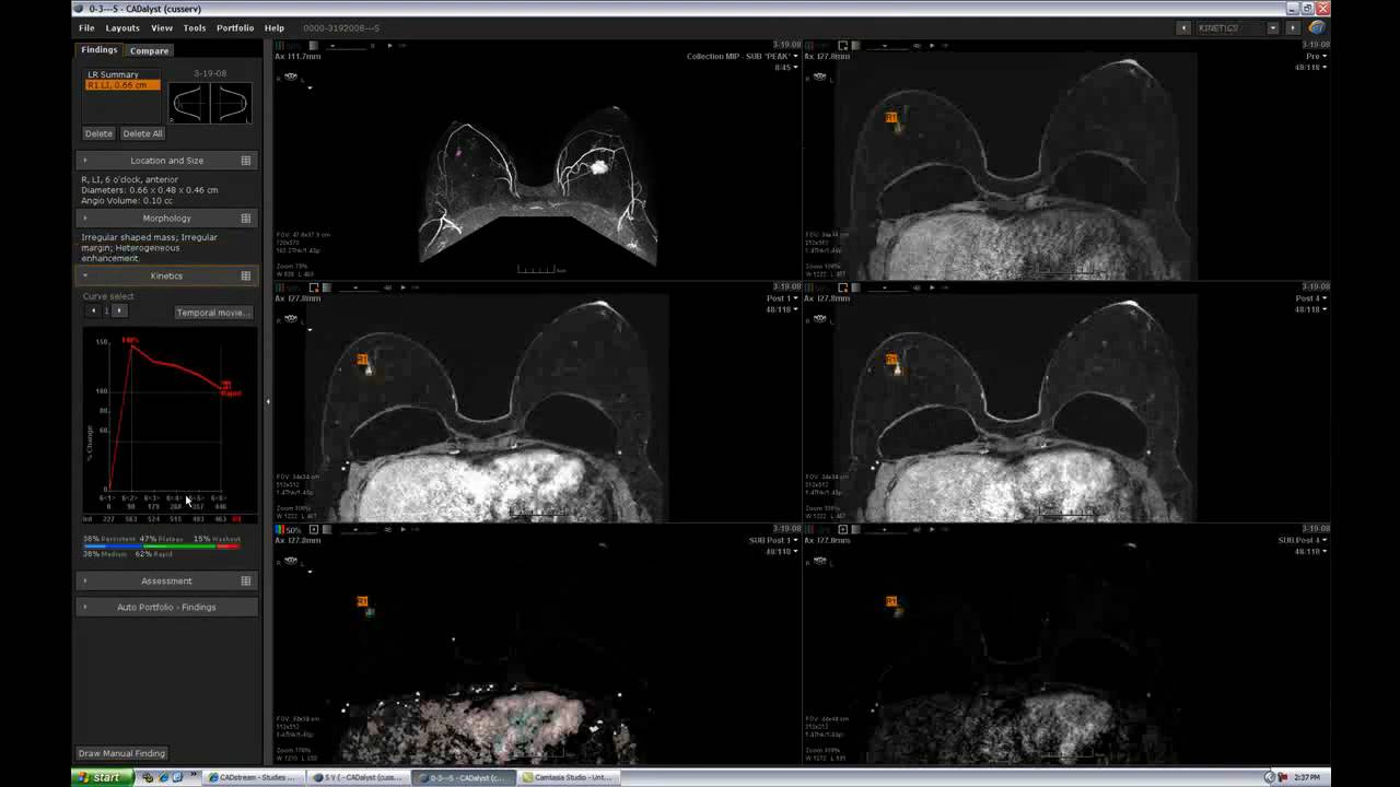CADstream MRI CAD Demonstration