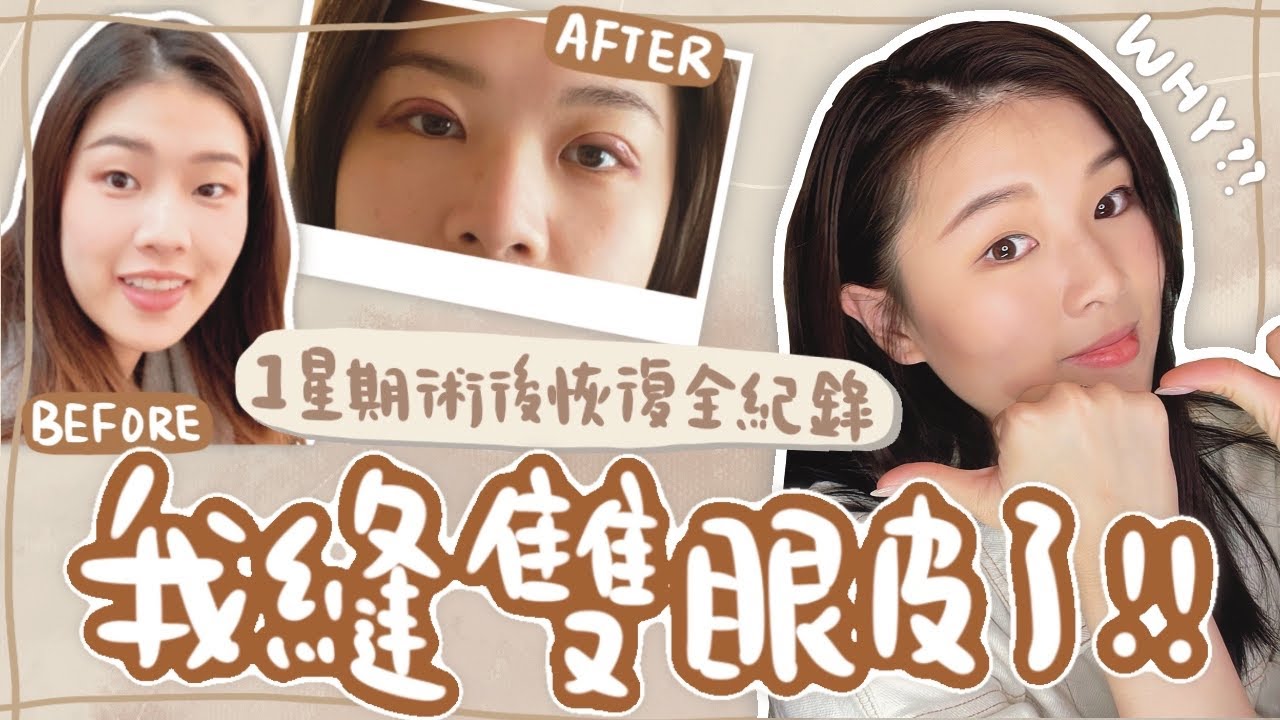 【縫雙眼皮】我縫了雙眼皮？！為什麼要做？在香港縫雙眼皮，術後第1-8天、3星期後的恢復日記｜ 極簡manting