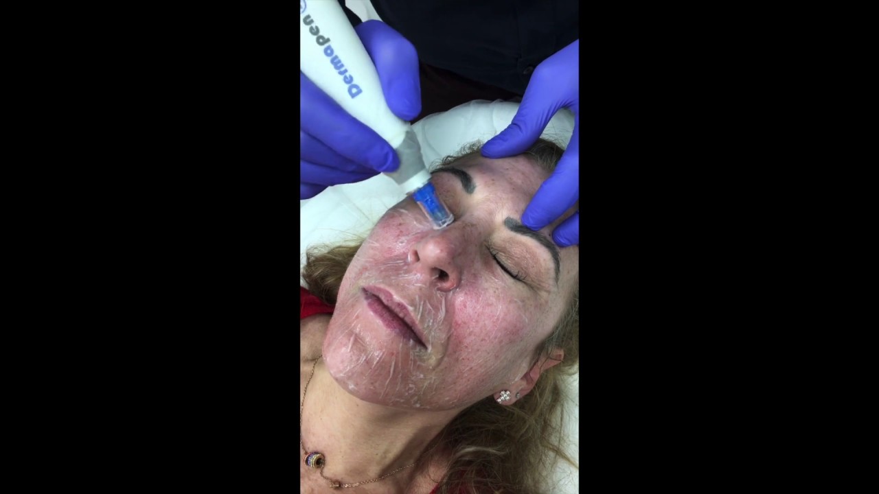 Τι είναι το Dermapen;  - Γιώργος Βελημβασάκης Πλαστικός Χειρουργός