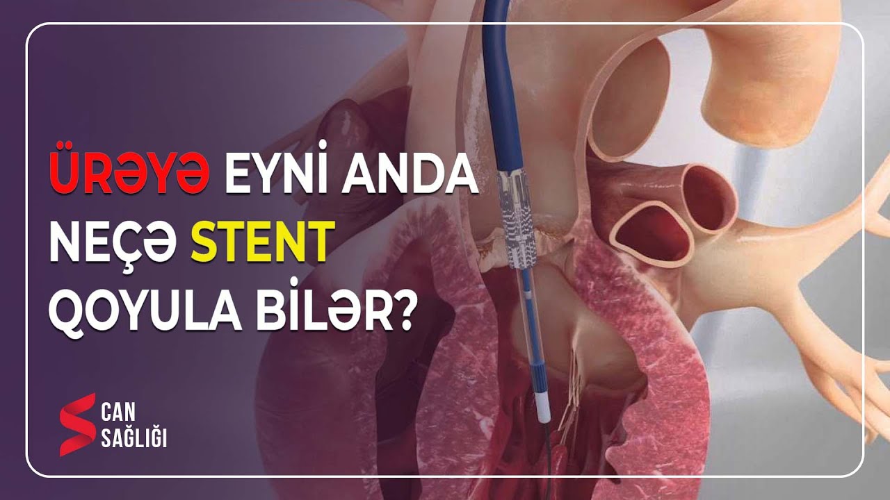 Ürəyə stentin qoyulması (06.07.2023) - Medical Meida Live