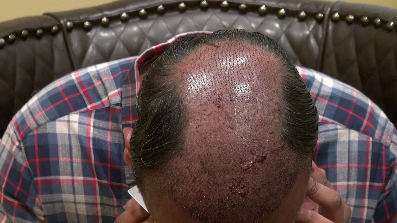 Hair Transplant 1 Day After Surgery Follow Up Progress Dr. Diep Bald 
