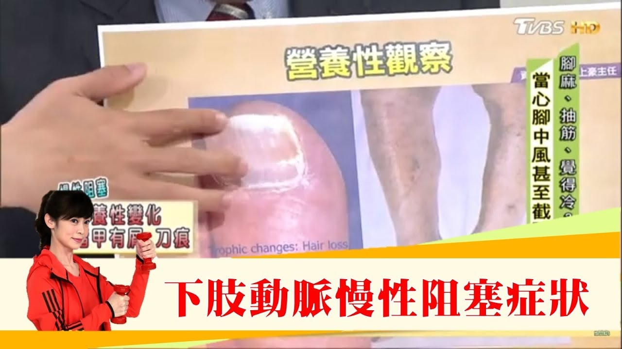腳中風恐截肢！教你觀察「下肢動脈慢性阻塞」遠離腳中風 健康2.0