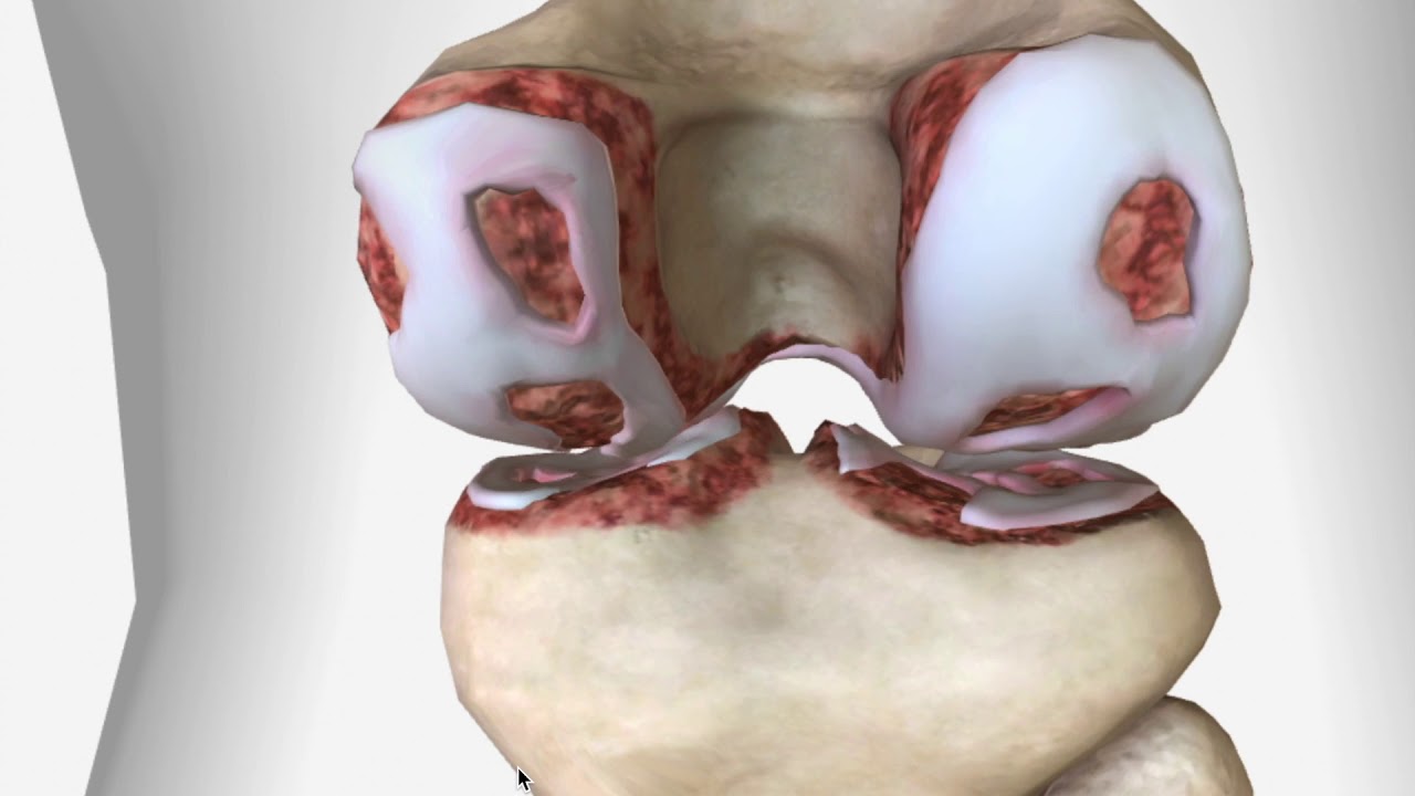 Knee Cracking Sound- What to know and what to do