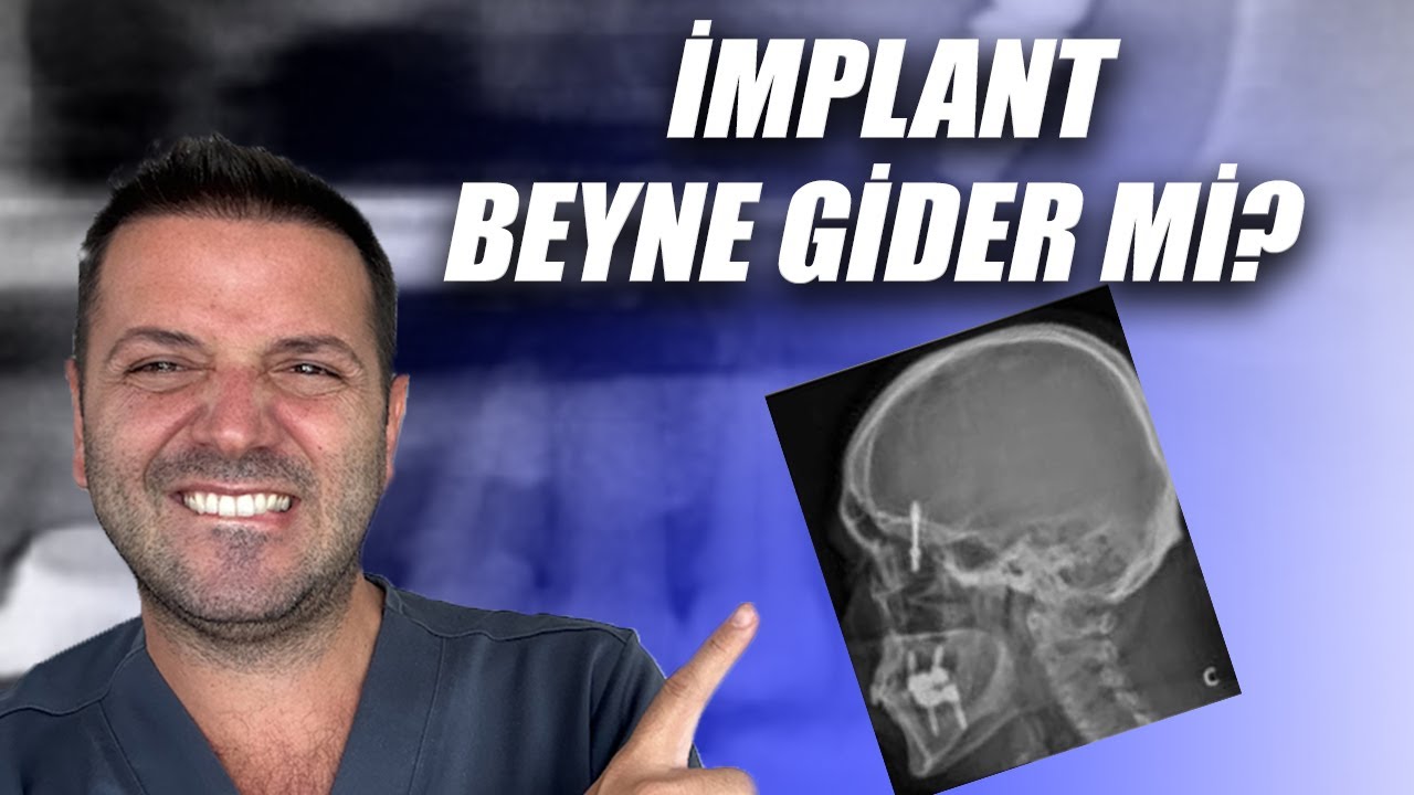 İmplant Beyne Gider mi? Sinüs İçine Kaçan İmplant Tomografide Nasıl İncelenir?