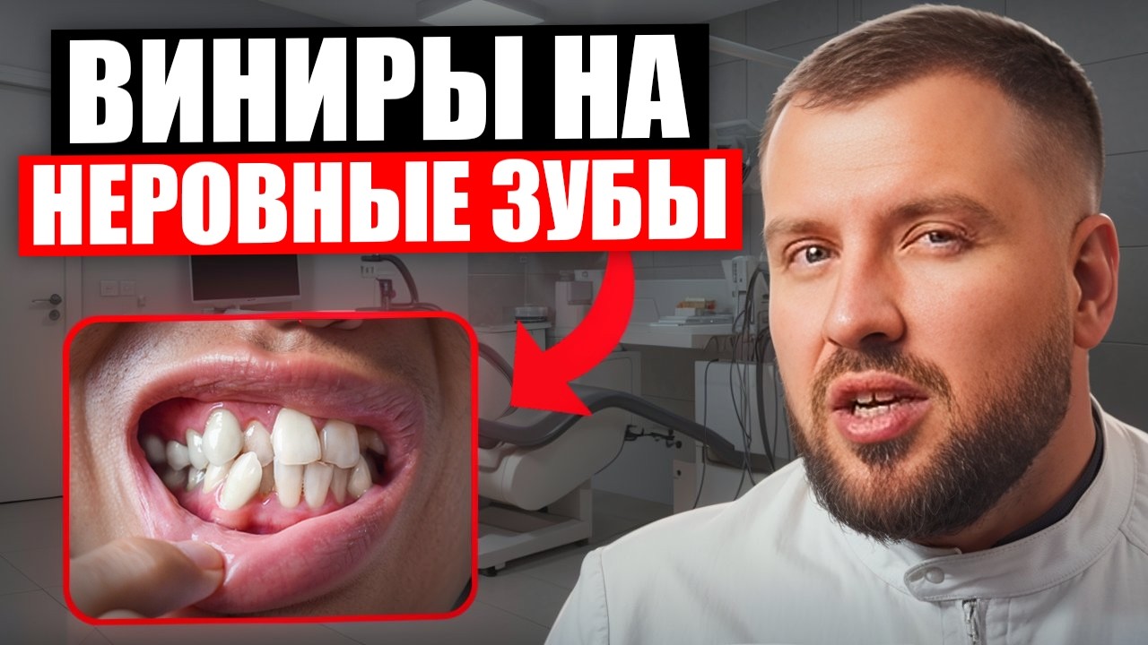 Виниры на кривые зубы.  Самая дорогая ошибка!
