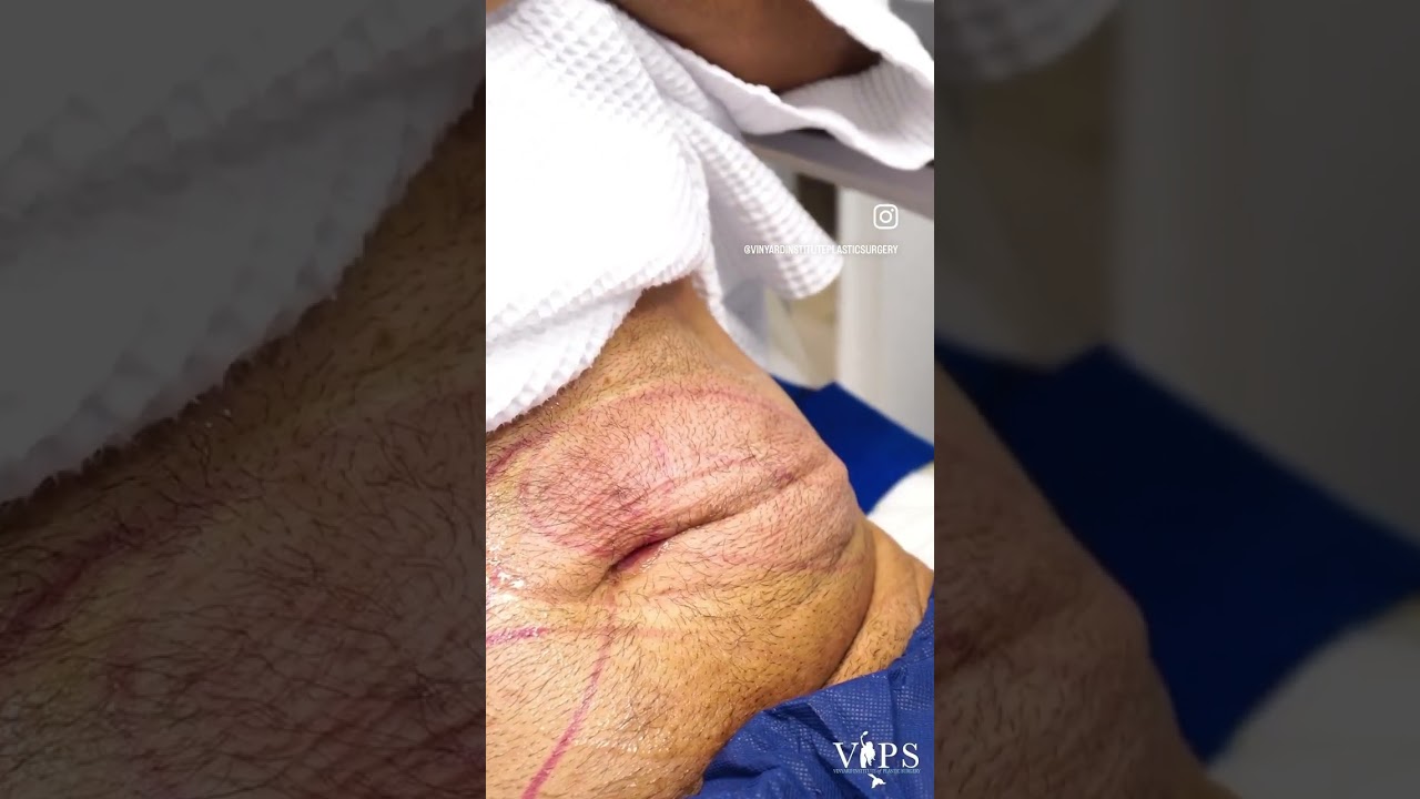 CoolSculpting Elite Live Patient Treatment