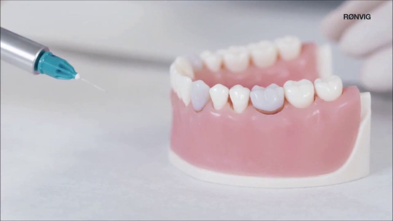 PAROJECT  A dental cartridge syringe for intraligamental local analgesia