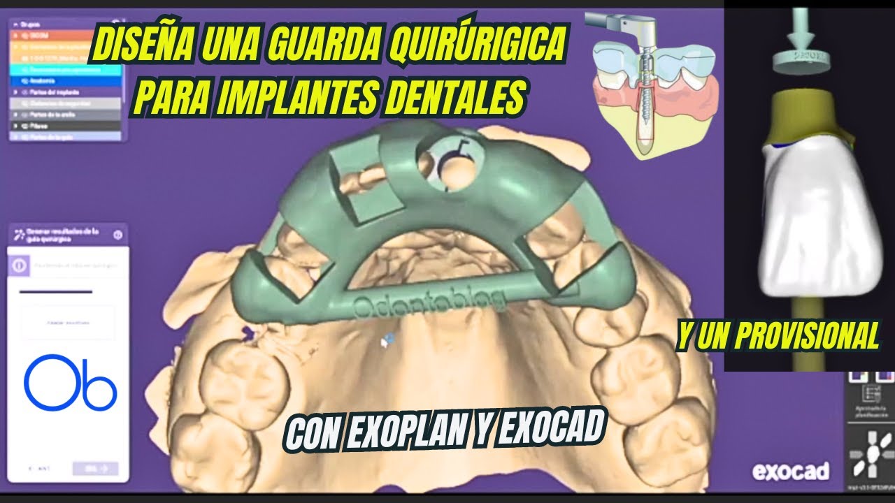 Diseña una guarda quirúrgica para Implantes dentales en exoplan y exocad con Dr Hugo Ochoa