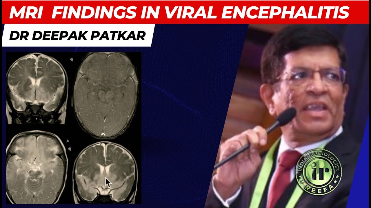 DR DEEPAK PATKAR || CNS INFECTIONS - Viral Encephalitis