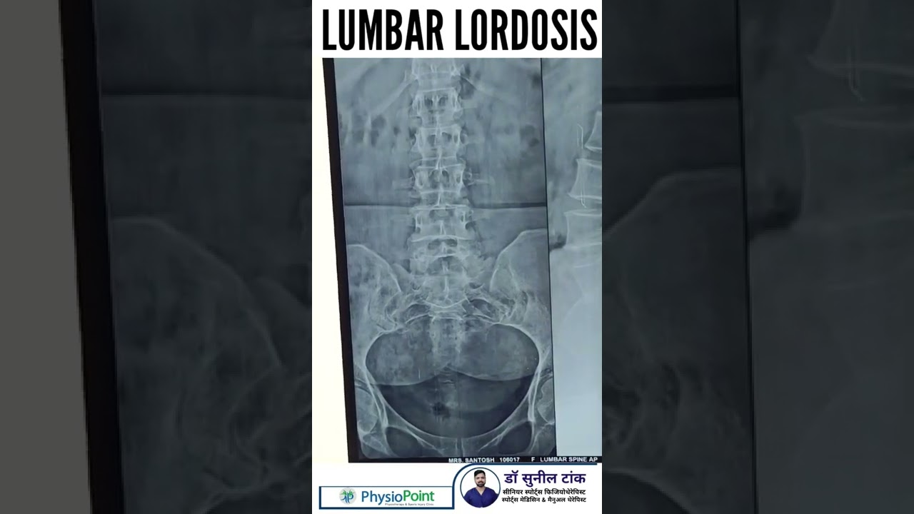 Lumbar lordosis - back pain - xray finding #shorts #backpain #lordosis #xray #posture #drsuniltank