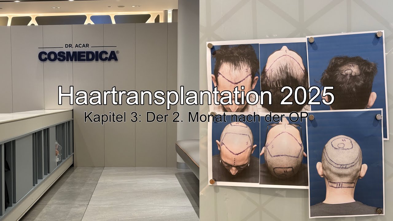 Haartransplantation 2025 - Kapitel 3: Der zweite Monat nach der OP
