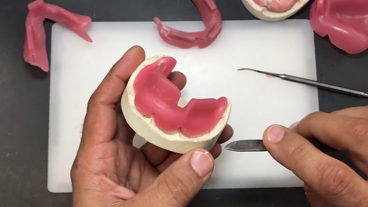 8b) Removal of Lower Custom Tray