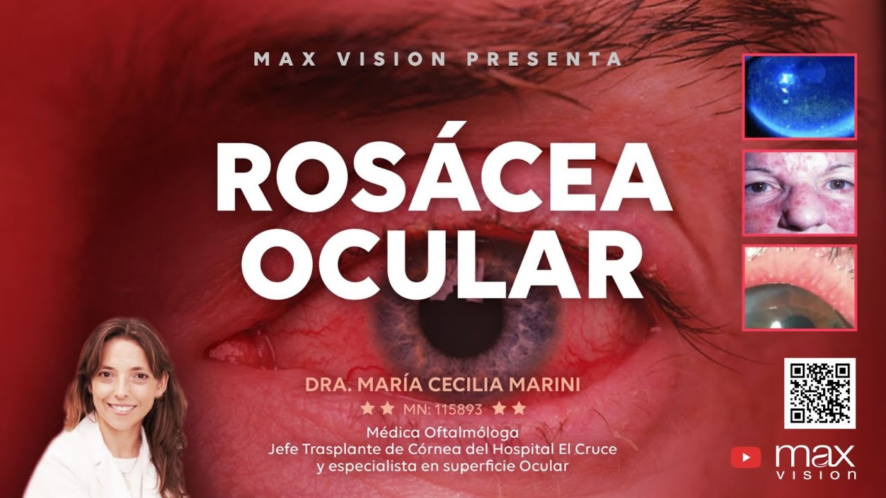 Dra. María Cecilia Marini - Rosácea Ocular.
