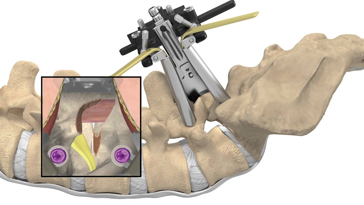 MAS TLIF Patient Animation